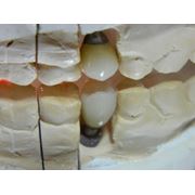 Имплантация зубов Днепропетровск цена фото