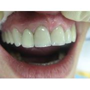 Протезирование зубов в Запорожье фото