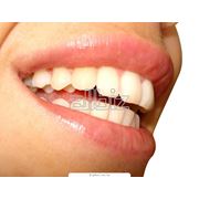 Выравнивание зубных рядов одиночно стоящих зубов ортодонтическая подготовка перед протезированием фото