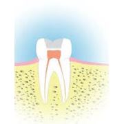 Пломбирование корневых каналов зубов фото