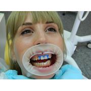 Лазерное отбеливание зубов Днепропетровск цена фото