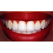 Полноценная функциональная и эстетическая реставрация зубов. фото