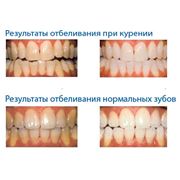Отбеливание зубов Запорожье. В нашей клинике мы используем Профессиональную Систему Безопасного Отбеливания YOTUEL производство Испания фотография