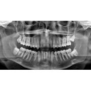 Ортопантомография. Панорамный (обзорный) рентген фотография