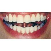 Диагностика жизнеспособности зуба фото