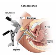 Кольпоскопия фото