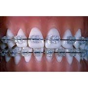 Выравнивание зубного ряда цена Киев. Выравнивание зубов Киев.Ортодонтия выравнивание зубного ряда зубов брекеты исправление. Выравнивание зубного ряда зубов фото