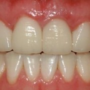 Керамические виниры на зубы фото