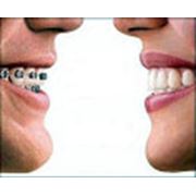 Ортодонтия исправление прикуса в Запорожье фотография