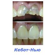 Лечение протезирование зубов металлокерамическими коронками фото