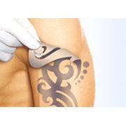 Лазерное удаление татуировок в Киевсеть клиник Лилайн фото