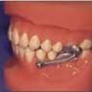 Лечение аномалий зубо-челюстной системы фотография