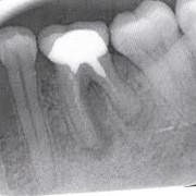Рентген зуба фото