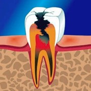 Терапевтическая стоматология. Лечение зубов фото