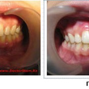 Пластика уздечек языка, верхней, нижней губ, Стоматологические услуги, Стоматология фото