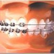 Ортодонтия фотография