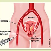 Лечение фибромиомы матки фото