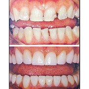Коррекция формы и положения зубов фото