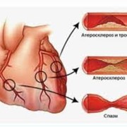 Лечение ишемической болезни сердца (ИБС) фото