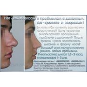 Пластическая хирургия носа, (ринопластика). Украина Цены по прайсу.