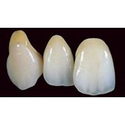 Зубные протезы из металлокерамики. Металлокерамика фото