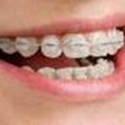 Лечение аномалий зубо-челюстной системы