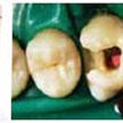 Лечение осложненного кариеса однокорневого зуба пульпит, периодонтит фото
