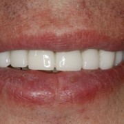 Профессиональная гигиена и отбеливание зубов