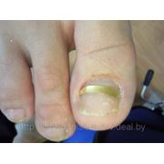 Ортониксия: коррекция вросшего ногтя — установка Золотой пластины фото