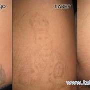 Лазерное удаление татуировок фото