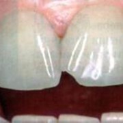 Кариес зубов, профилактика и лечение кариеса фотография