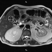 Магнитно-резонансная томография органов брюшной полости