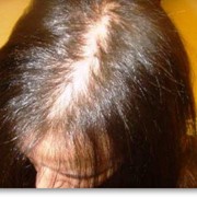 Выпадение волос у женщин, эликсир от выпадения фото