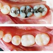 Пломбирование корневых каналов зубов фотография