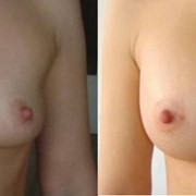 Увеличение груди фото
