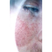 Лечение лазером расширенных сосудов кожи (лазерная фотодеструкция) фото