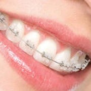 Ортодонтическое лечение фотография