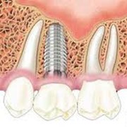 Имплантация зубов