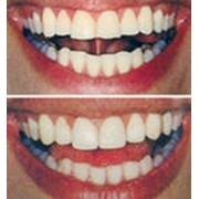 Художественная реставрация зубов фото