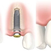 Имплантация зубов в Костанае