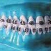 Коррекция формы и положения зубов