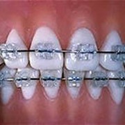 Выравнивание зубного ряда фото