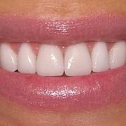 Эстетическая реставрация фронтальных зубов