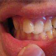 Отбеливание зубов ZOOM фотография