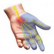 Лечение боли и онемения в кисти рук в алматы