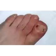 Лечение и удаление вросшего ногтя Услуги хирургические Хирургия фото