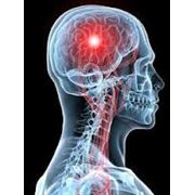 Лечения сосудистых заболеваний мозга Неврология и невропатология фото