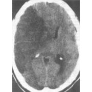 Лечение церебро-васкулярной болезни Неврология и невропатология фото