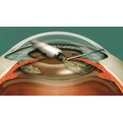 Факоэмульсификация катаракты с имплантацией ИОЛ фотография