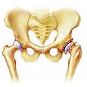 Лечение остеоартроза тазобедренного сустава в алматы фото